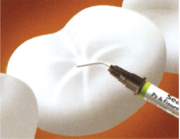 シーラントの使用のイメージ図